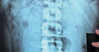 Beweismittel. Die R&ouml;ntgenaufnahme zeigt mehrere der Fingerlinge im Darm eines Bodypackers. 