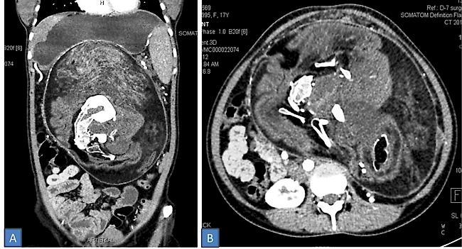 In der Mitte ist der fehlentwickelte Zwilling zu sehen. (CT-Scan)